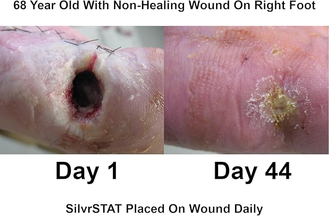 SilvrSTAT First Aid Kit Gel, 32 PPM Silver Healing Wound Dressing Gel, SilverSol Ag₄O₄ Particles, 1 oz